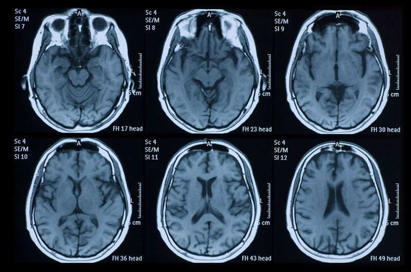 Các phương pháp chẩn đoán hình ảnh hiện đại được sử dụng để chẩn đoán chấn thương sọ não