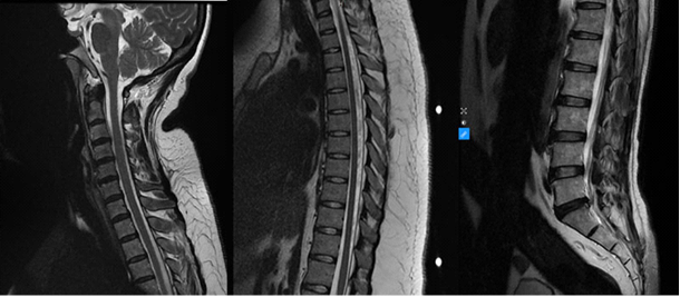 Chụp cộng hưởng từ cột sống cổ - lưng – thắt lưng