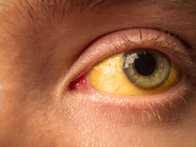 Vàng mắt là triệu chứng dễ thấy của bệnh viêm gan C 