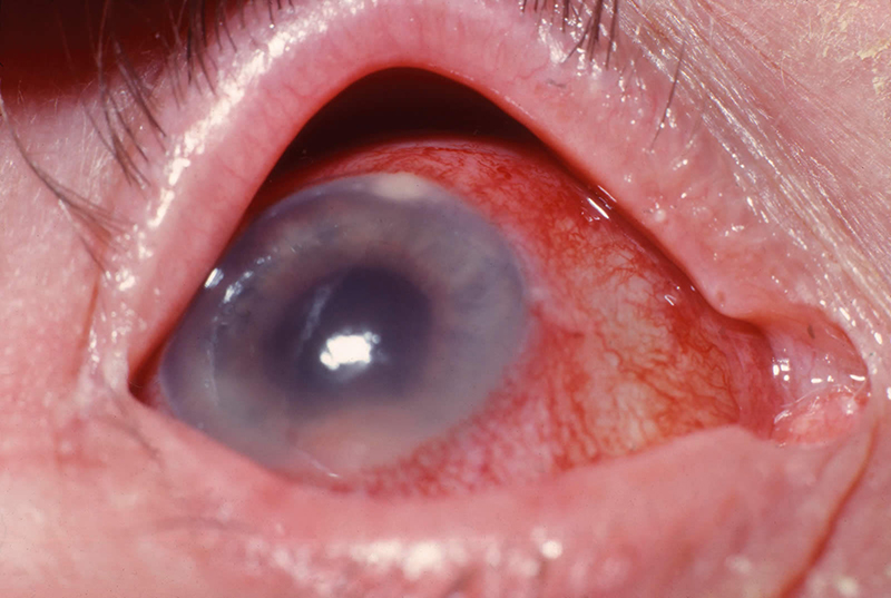 Viêm nội nhãn là tình trạng viêm của các mô bên trong mắt và có thể gặp ở bất cứ ai