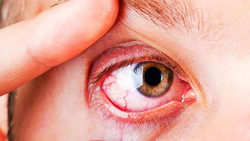 Viêm mủ nội nhãn gây ra tình trạng sưng, đỏ với mắt