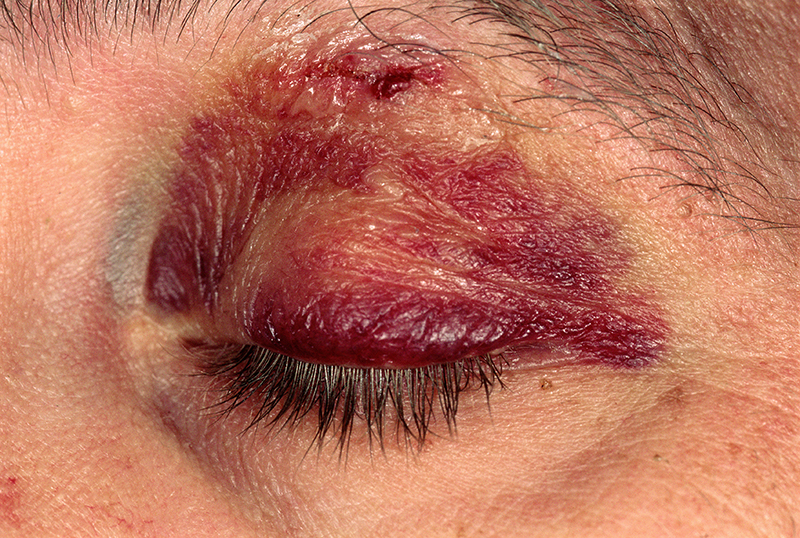 Các chấn thương tại mắt là yếu tố làm tăng nguy cơ gây bệnh