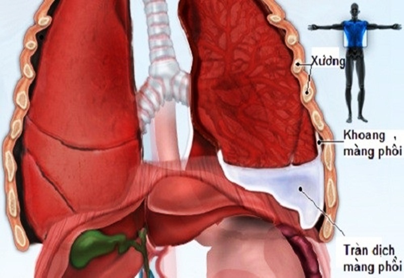 Tràn dịch màng phổi có thể tiến triển nhanh chóng gây nguy hiểm cho người bệnh