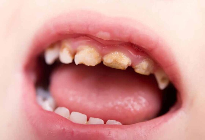  Trẻ lười đánh răng dễ bị sâu răng và các bệnh lý răng miệng khác