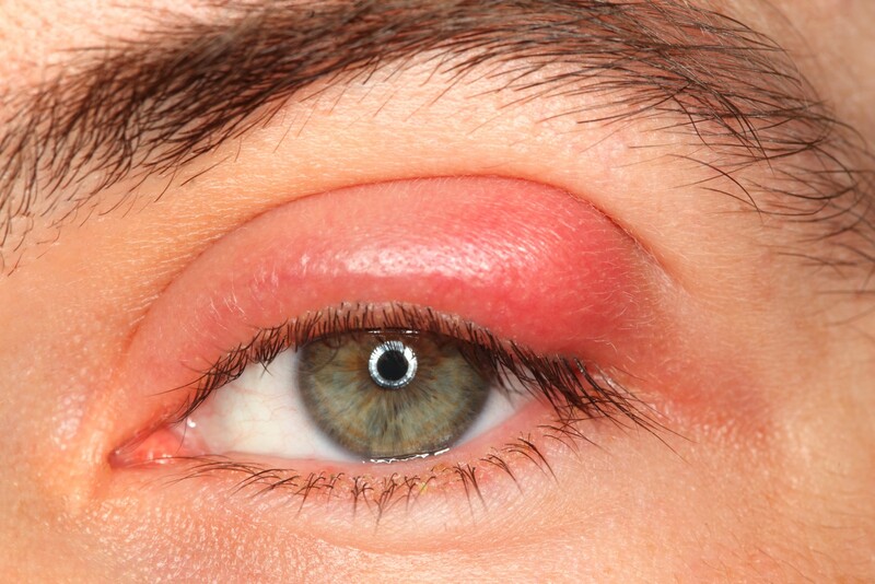 Viêm xoang rất dễ biến chứng đến mắt gây nhiễm trùng, giảm thị lực