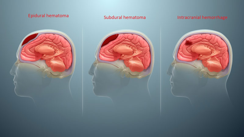 Tình trạng tụ máu não có nhiều cấp độ khác nhau