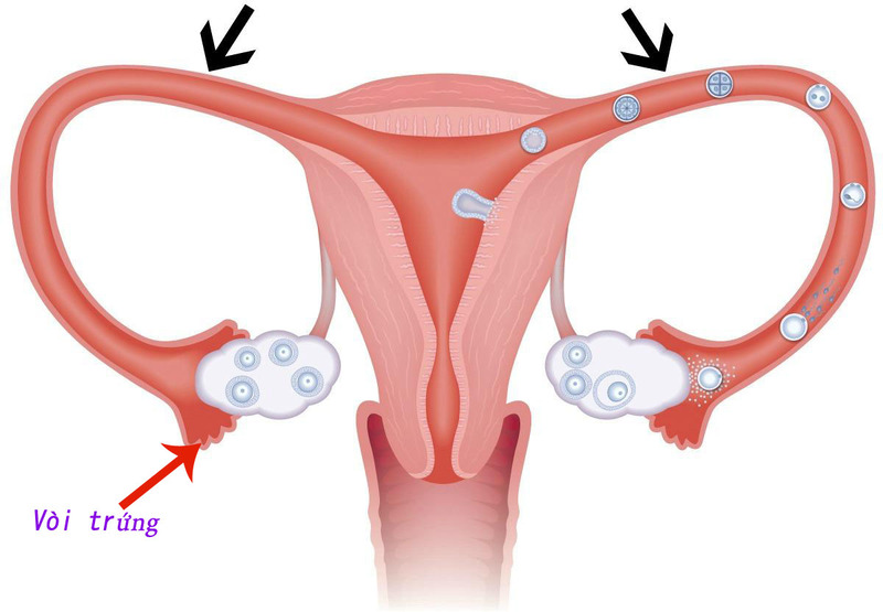 Thai nằm ngoài tử cung có thể do cấu trùng vòi trứng không bình thường