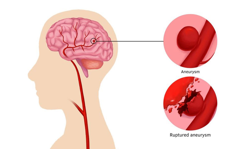 Hiện tượng vỡ mạch máu não có thể để lại nhiều di chứng xấu
