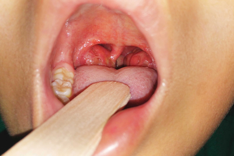  Vệ sinh răng miệng không tốt có thể là nguyên nhân gây viêm mũi họng cấp