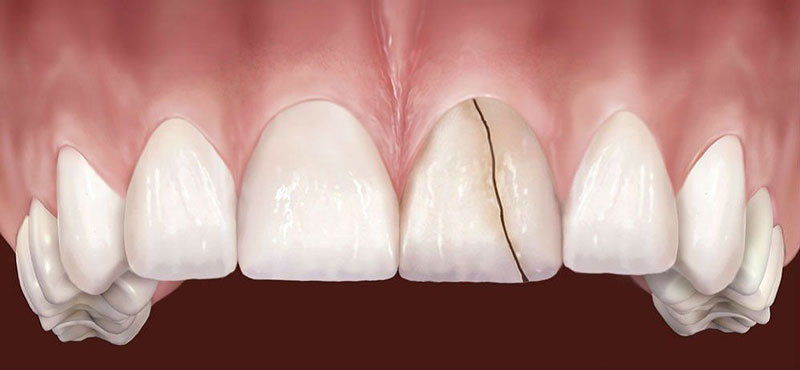 Nứt răng là một trong những nguyên nhân làm răng nhạy cảm