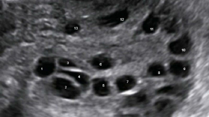Hình ảnh siêu âm phát hiện đa nang buồng trứng