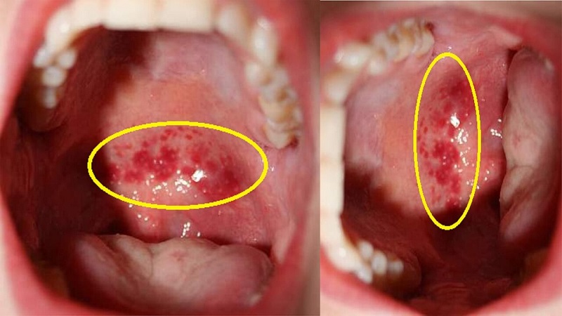 Viêm họng hạt gây ra những hạt nhỏ li ti như hạt đậu ở cổ họng
