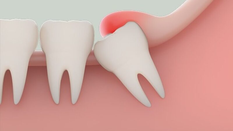 Răng khôn mọc chen lấn sang các răng bên cạnh gây đau đớn nghiêm trọng