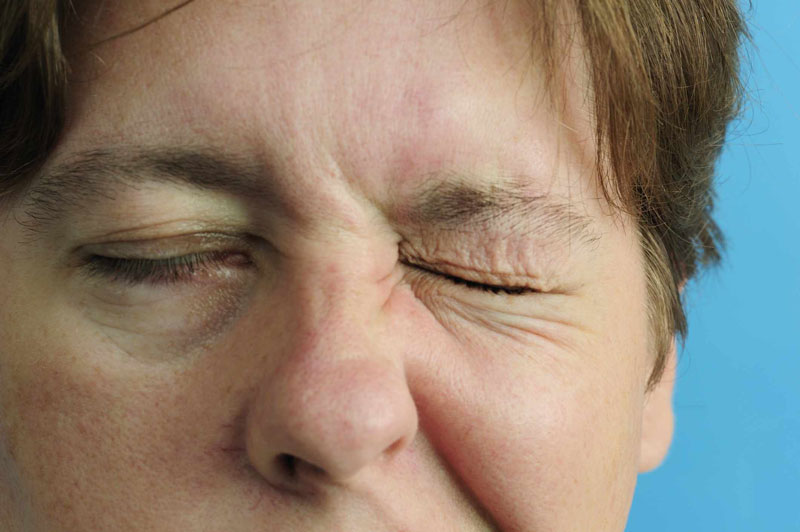 Bệnh liệt bell gây mất thẩm mỹ cho gương mặt bệnh nhân