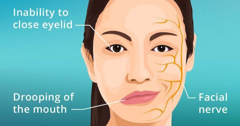 Tình trạng bại liệt khuôn mặt xảy ra do nhiều nguyên nhân