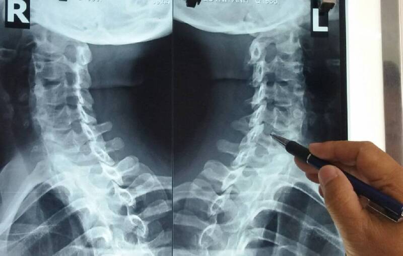 Hầu hết ưỡn cột sống được chẩn đoán bằng chụp X-quang