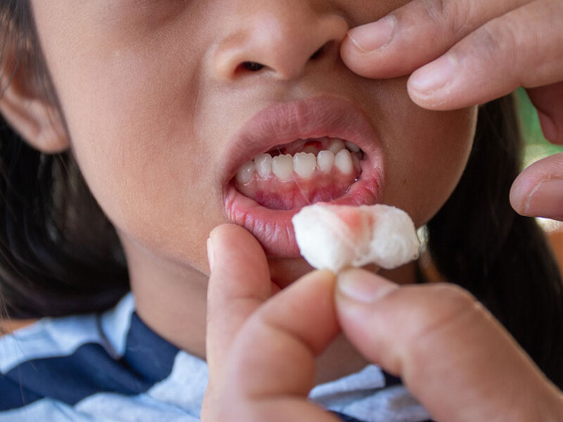 Chảy máu nướu răng là tình trạng thường gặp mà nhiều người bỏ qua