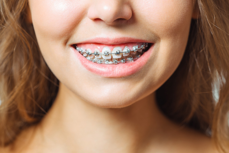 Để khắc phục tình trạng răng mọc lung tung, chen chúc, răng hô móm hoặc thưa, nhiều người đã tìm đến phương pháp niềng răng