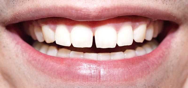 Răng mọc cách xa nhau, có khe hở rộng giữa các răng là biểu hiện thường gặp của người bị thưa răng