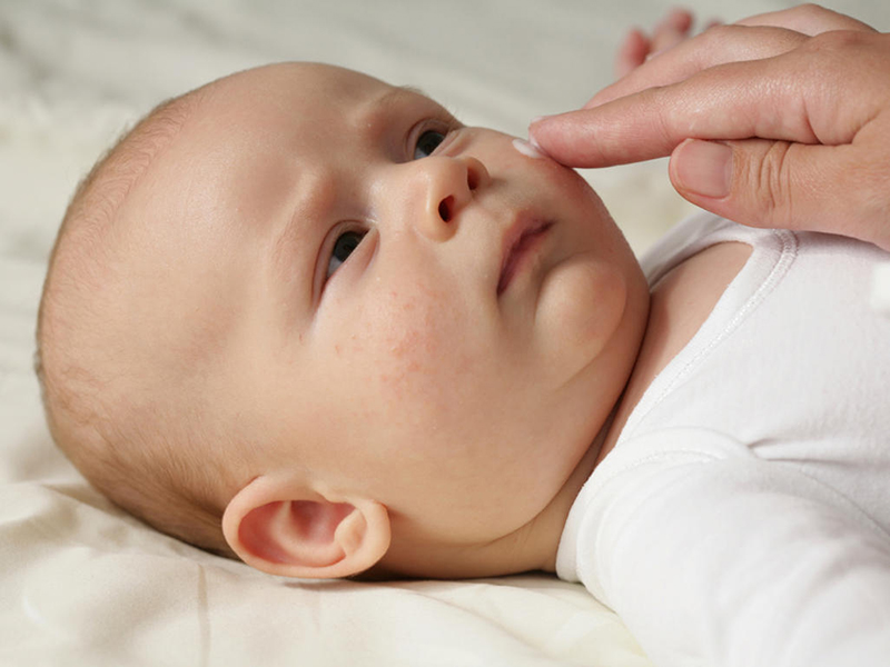 Vết chàm ở má thường xuất hiện ở trẻ sơ sinh dưới 6 tháng tuổi