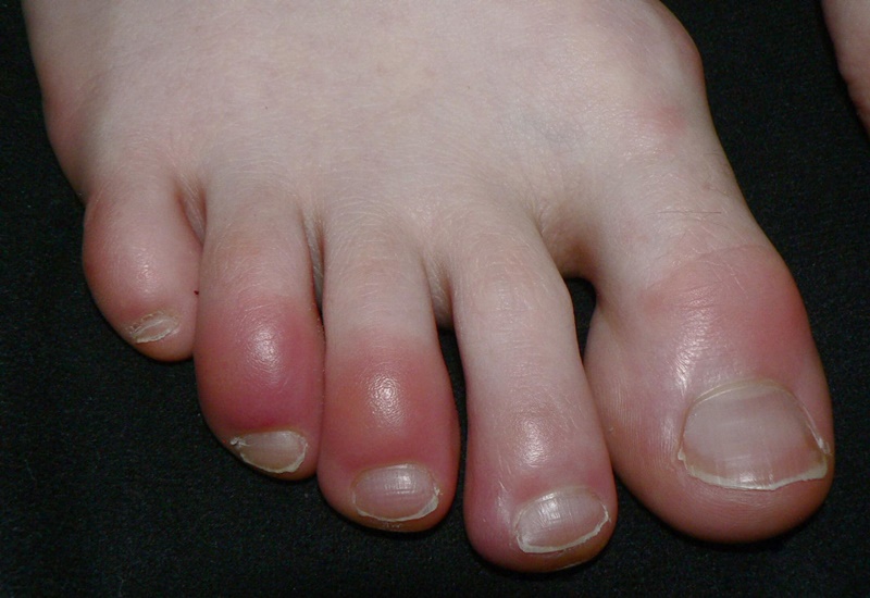 Đầu ngón chân của người bị cước có hiện tượng sưng đỏ