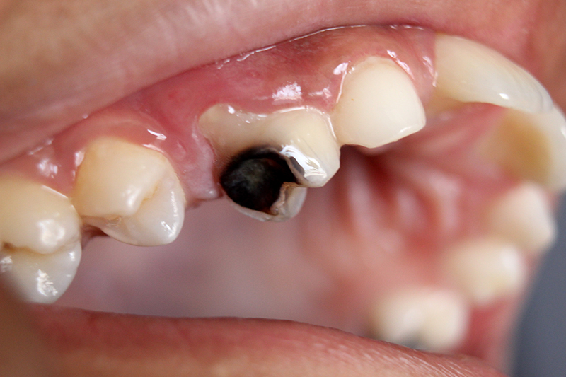 Sâu răng, viêm nha chu, các bệnh lý về răng miệng,… khiến vi khuẩn tấn công và làm suy yếu men răng