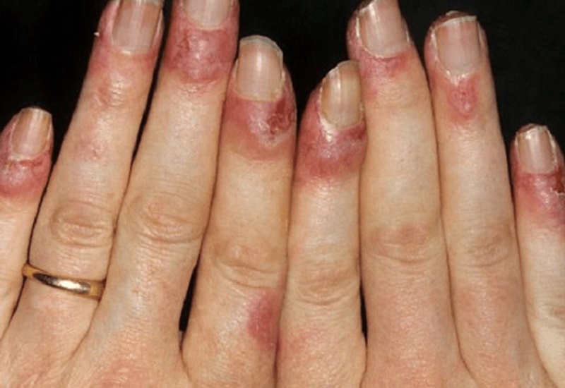 Cước tay có thể do một số bệnh lý về da