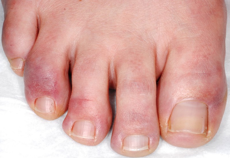 Triệu chứng cước chân mang đến nhiều phiền toái cho người bệnh