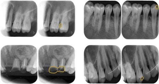 Chụp x quang răng giúp phát hiện các tổn thương tại răng