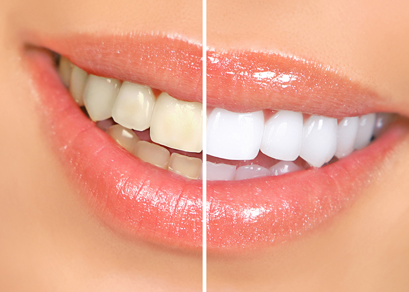 Răng trắng sáng làm cho nụ cười thêm phần rạng rỡ