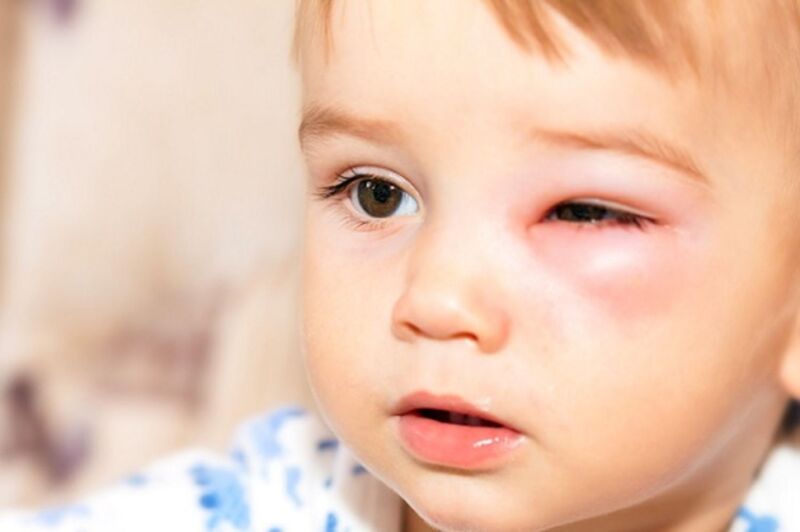 Viêm mô tế bào có thể xảy ra ở vùng da ổ mắt