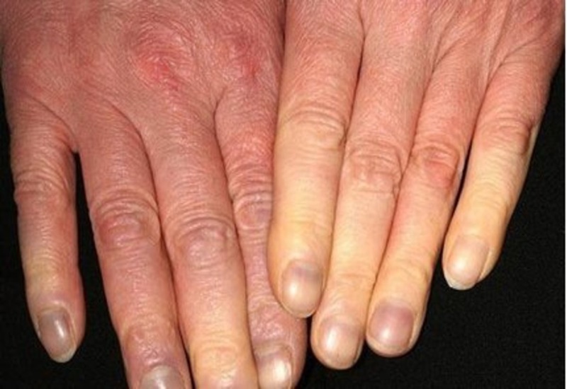 Triệu chứng bệnh cước thường xuất hiện ở ngón tay