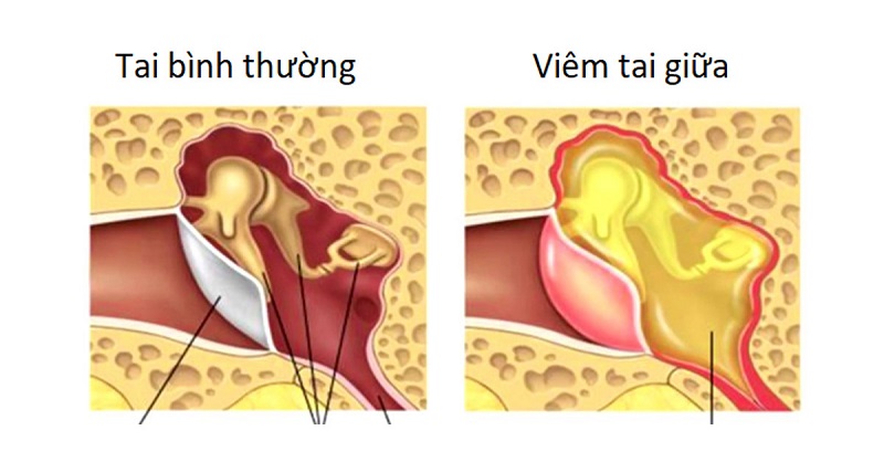 Viêm tai giữa là một trong những nguyên nhân khiến tai bị chảy mủ