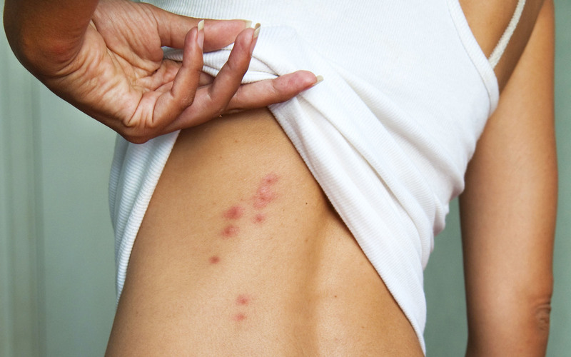 Viêm da có thể kết hợp với sẩn ngứa trên da khi tiếp xúc với ánh nắng