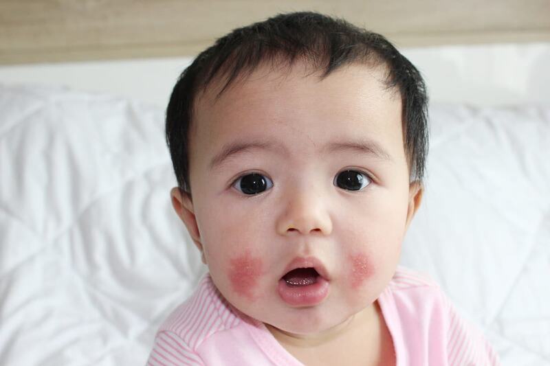 Viêm da tiết bã ở trẻ có thể xảy ra ở vùng da má