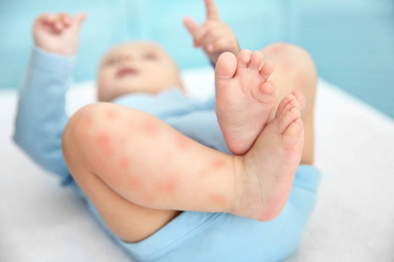  Viêm da tiết bã ở trẻ sơ sinh thường tự hết khi trẻ lớn hơn