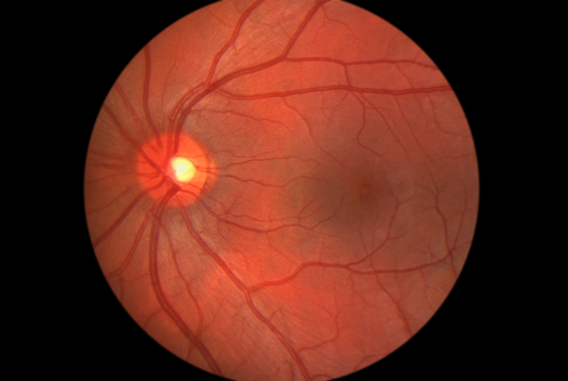 Bong dịch kính là một tình trạng thường không gây nguy hiểm cho mắt