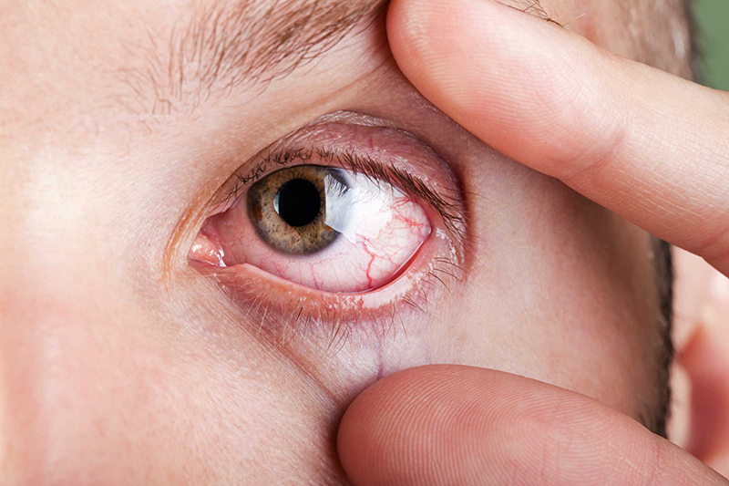 Một số ít trường hợp bị bong dịch kính sẽ gặp phải các biến chứng gây ảnh hưởng đến thị lực