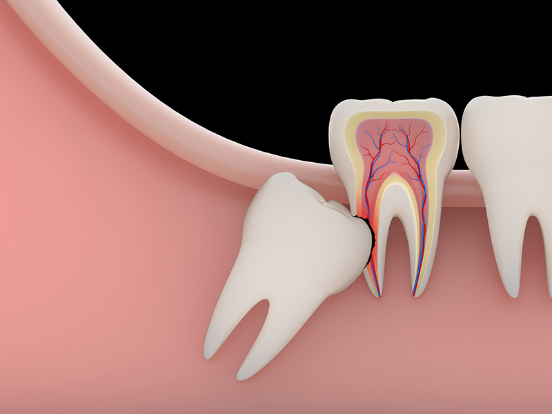 Răng khôn mọc không đúng vị trí, gây ảnh hưởng đến hoạt động ăn uống, sức khỏe răng miệng nên nhiều người muốn loại bỏ chúng
