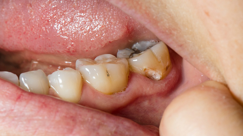 Tình trạng chảy máu kéo dài có thể do nha sĩ nhổ đúng răng bị viêm hoặc do bạn mắc phải các bệnh như: sâu răng, viêm nha chu,…