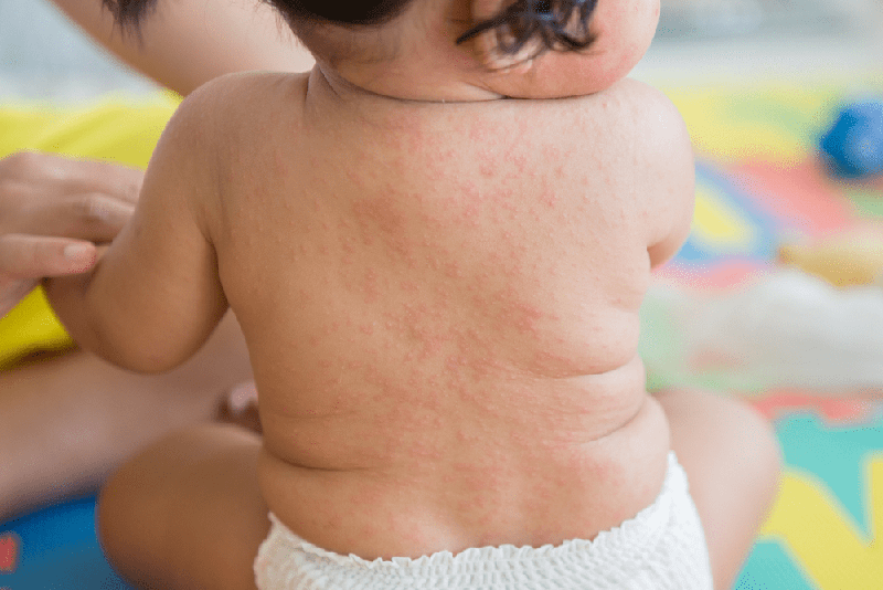 Phát ban sau sốt là tình trạng phổ biến ở trẻ 6 tháng - 3 tuổi