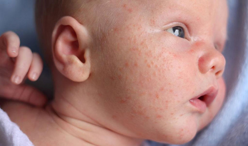Bệnh ban đỏ nhiễm khuẩn thường xuất hiện đầu tiên trên 2 má của trẻ