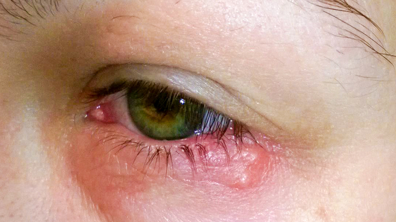 Số người bị nhiễm bệnh nấm mắt ở Việt Nam khá cao