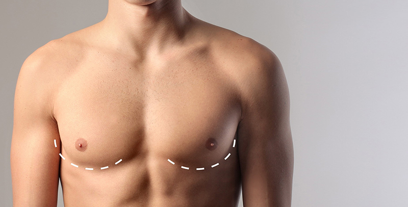 Bệnh ngực to ở đàn ông chỉ tình trạng tăng kích thước mô vú 