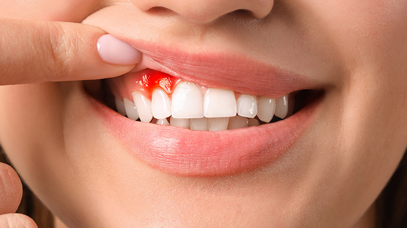   Viêm lợi là vấn đề răng miệng phổ biến ở mọi lứa tuổi