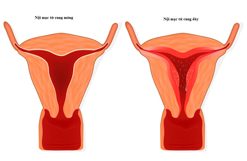 Độ dày của lớp niêm mạc tử cung có ảnh hưởng trực tiếp với khả năng mang thai ở nữ giới