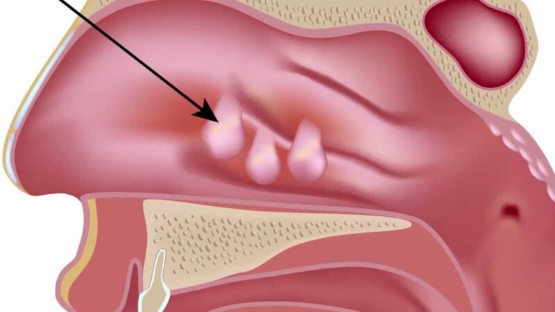 Polyp là những khối u mềm hình thành ở niêm mạc mũi