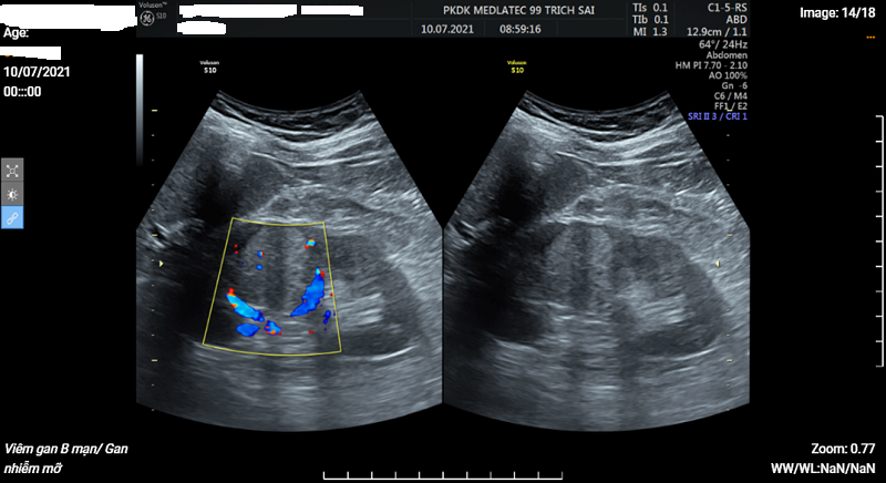 Hình ảnh siêu âm của bệnh nhân T.H phát hiện khối u ở thận trái
