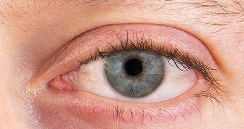 Bệnh khô mắt kéo dài gây ảnh hưởng không nhỏ đến thị lực