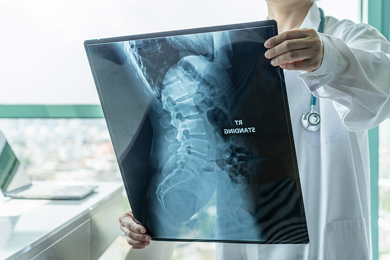 Chẩn đoán viêm cột sống dính khớp bằng hình ảnh X-quang hoặc MRI